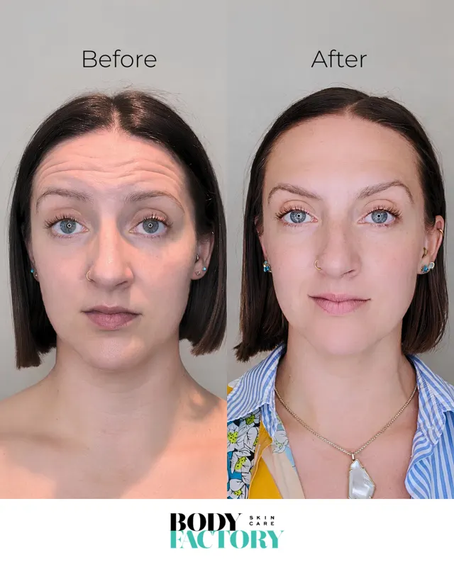 BodyFactory Botox Social Post: Before and After Carousel, Slide 1