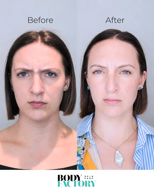 BodyFactory Botox Social Post: Before and After Carousel, Slide 2