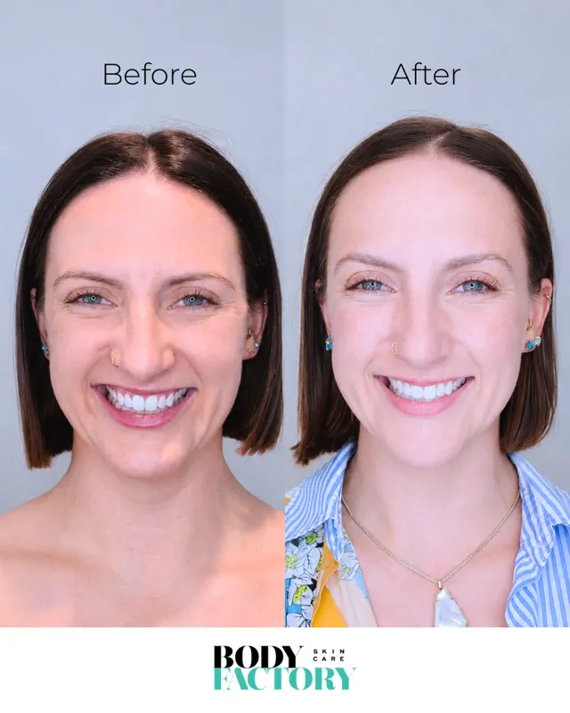 BodyFactory Botox Social Post: Before and After Carousel, Slide 3