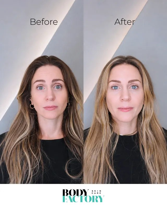 BodyFactory Botox Social Post: Before and After Carousel, Slide 4