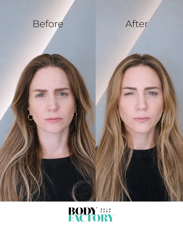 BodyFactory Botox Social Post: Before and After Carousel, Slide 5