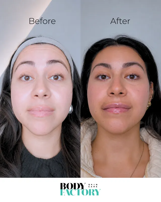 BodyFactory Botox Social Post: Before and After Carousel, Slide 6