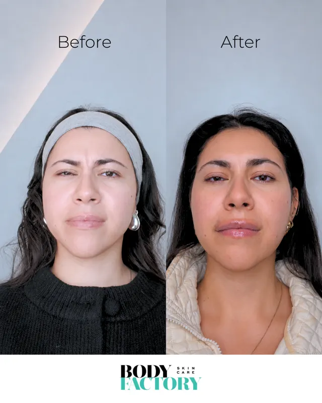 BodyFactory Botox Social Post: Before and After Carousel, Slide 7