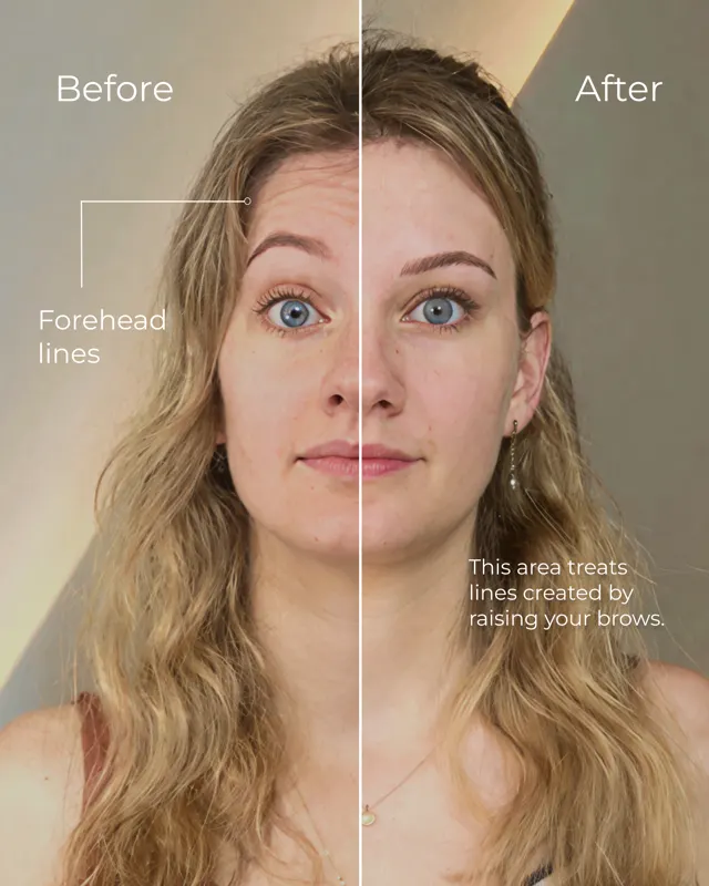BodyFactory Botox Social Post: $400 Flat Fee Carousel, Slide 1