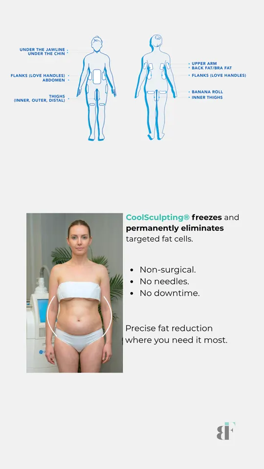 BodyFactory CoolSculpting Social Post: Carousel, Slide 3