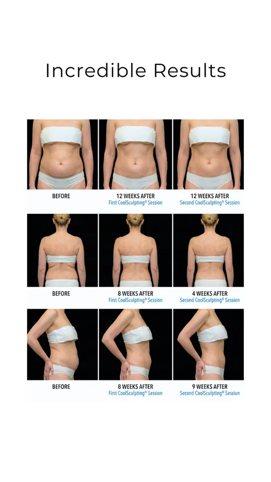 BodyFactory CoolSculpting Social Post: Carousel, Slide 4