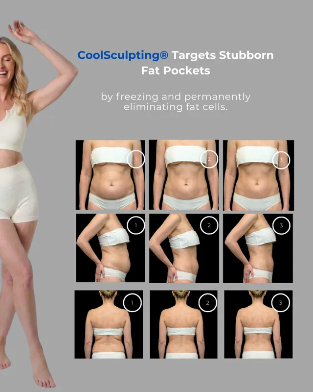BodyFactory CoolSculpting Social Post: GLP1Weight Loss, Panel, #3