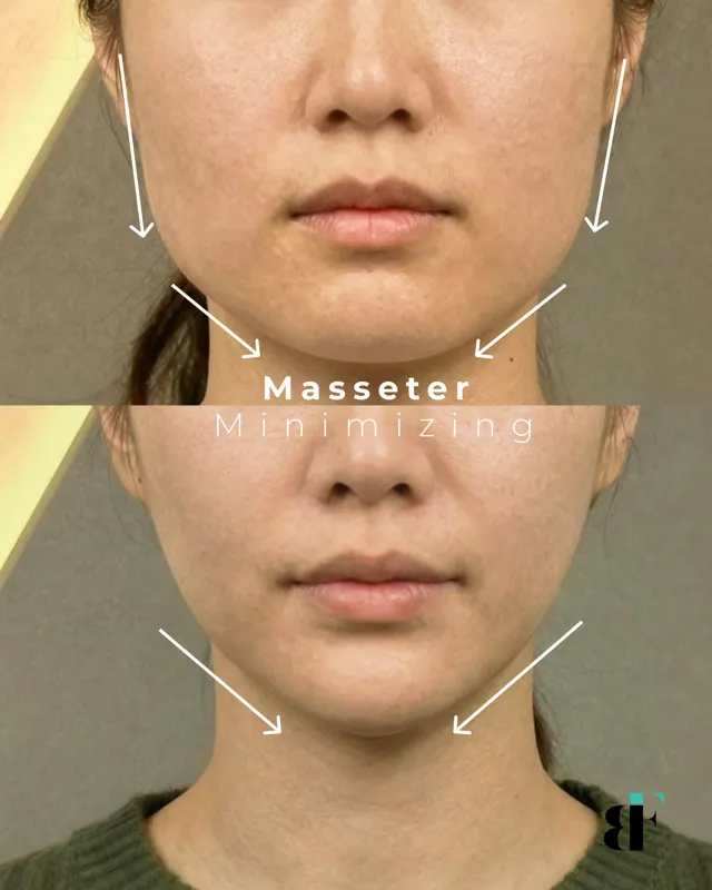 BodyFactory Masseter Social Post: Carousel, Slide 5