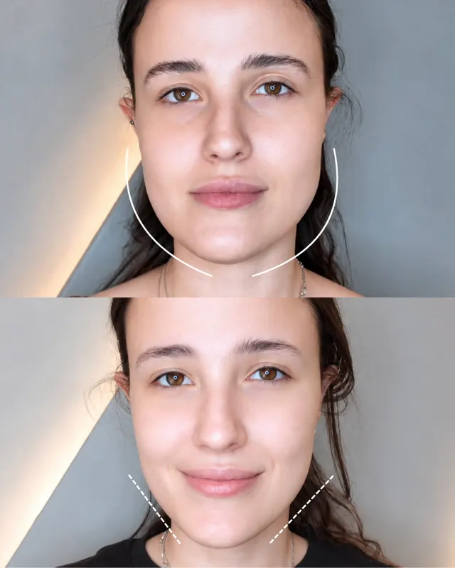 BodyFactory Masseter Social Post: Jawline Treatment, #1