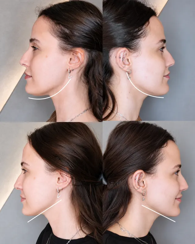 BodyFactory Masseter Social Post: Jawline Treatment, #2